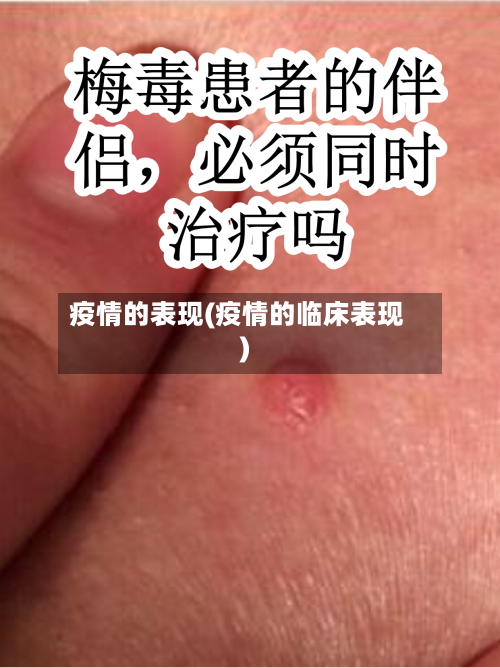 疫情的表现(疫情的临床表现)-第2张图片